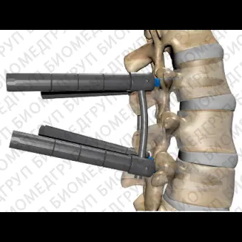 Система остеосинтеза для грудопоясничной зоны evospine MIS