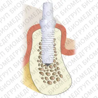 Цилиндрический зубной имплантат Z5m