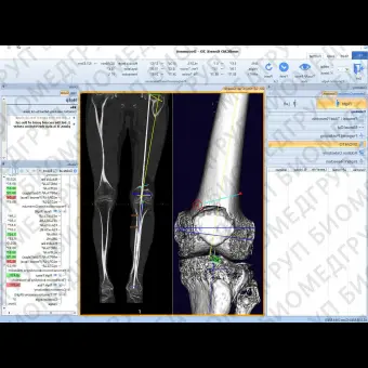 Медицинское программное обеспечение mediCAD 3D Knee