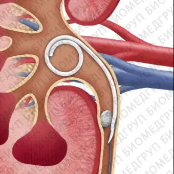 Мочеточниковый стент JFil MiniJFil