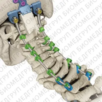 Шейногрудная система остеосинтеза SOLANAS