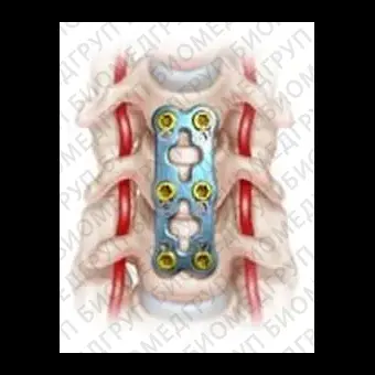 Шейная костная пластина для артродеза SKYLINE