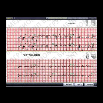 Система управления для анализа INFINITT EKG/ECG