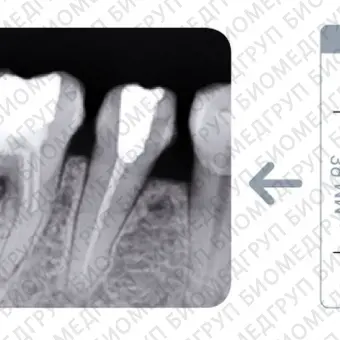 Vatech EzSensor Стоматологический радиовизиограф