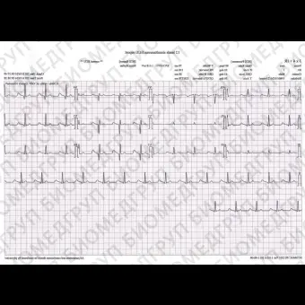 Электрокардиограф для спокойного состояния PE1201