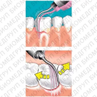 Sonicflex paro 60 A  длинная прямая насадка с закругленной верхушкой для минимально инвазивной терапии пародонтита