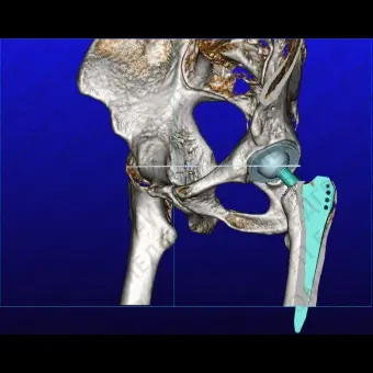 Программное обеспечение TDM mediCAD 3D Hip