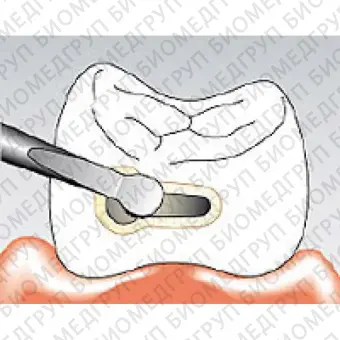 Sonicflex bevel 59  насадка для минимально инвазивной терапии кариеса с алмазным покрытием, дистальная