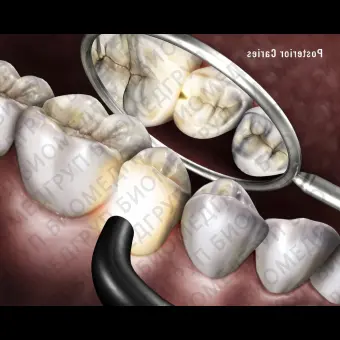 Детектор кариеса диафаноскопией Microlux 2