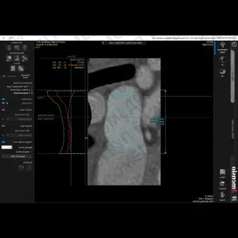 Анатомическое программное обеспечение 3mensio Pulmonary valve