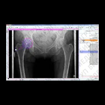 Программное обеспечение для хирургии тазобедренного сустава Hip Arthroplasty