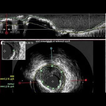 Программное обеспечение для исследования сосудов CAAS IVUS OCT