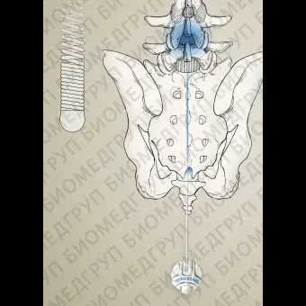 Катетер для невролиза ST.COX