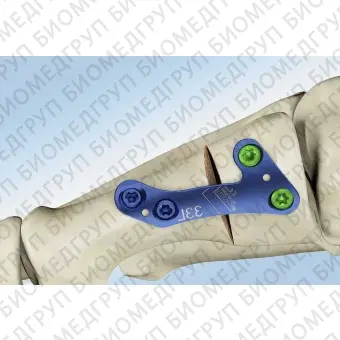 Костная пластина для остеотомии искривление большого пальца стопы наружу MetaFix BLP