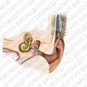 Имплантат среднего уха внутренняя часть SAMBA 2