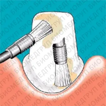 Sonicflex clean brush 3  насадкащетка конус малый для чистки зубов