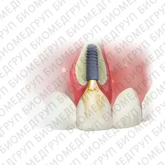 Цилиндрический зубной имплантат Ankylos