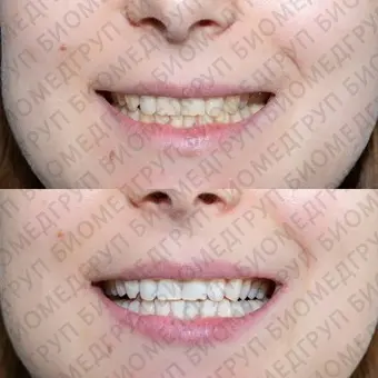 Amazing White Premium Teeth Whitening Kit 38  набор для клинического отбеливания