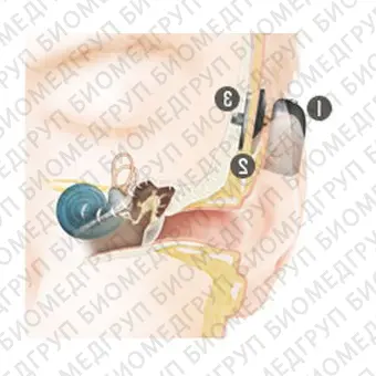 Слуховой имплантат с костной проводимостью внутренняя часть Baha Attract