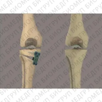 Костная пластина для остеотомии большеберцовая кость OWO