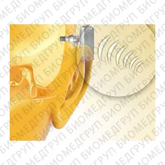 Слуховой имплантат с костной проводимостью внутренняя часть Baha Connect