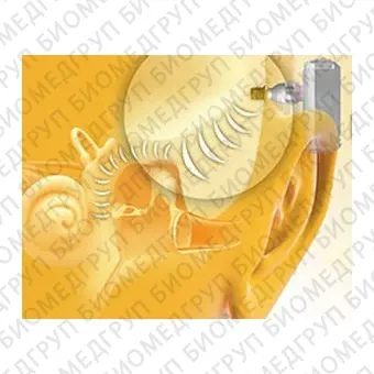 Слуховой имплантат с костной проводимостью внутренняя часть Baha Connect
