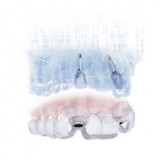 Программное обеспечение для стоматологической имплантологии SIMPLANT®