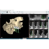 Программное обеспечение для стоматологической имплантологии NemoScan