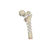Ортопедическая проволока для контроля протеза бедра Ortholox® UHMWPE